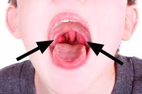 Mandelentzundung Streptokokken Angina