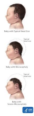 What will my baby look like. Facts About Microcephaly Cdc