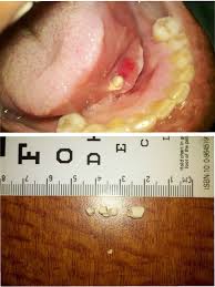 Image result for Sialolithiasis