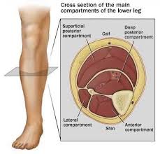 Image result for Compartment Syndrome