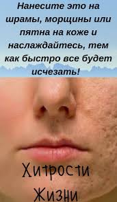 как быстро избавиться от пятен после прыщей на лице Nanesite Eto Na Shramy Morshiny Ili Pyatna Na Kozhe I Naslazhdajtes Tem Kak Bystro Vse Budet Ischezat Health Motivation Health Tonic Beauty Health