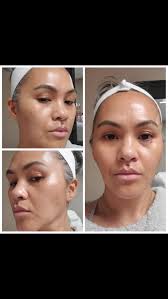 Have you ever had microneedling? With PRP? It's also a great way to promote  collagen production that helps reduce scar and hyperpigmentation through  skin cell turn over, and achieve skin rejuvenation. ...