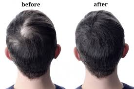 If you're experiencing hair thinning on the frontal area of the scalp, it's highly advisable to tackle this area first, before attempting to restore the crown. Progression Of Hair Loss In Men Darling Hair Restoration