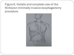 Transhiatal ivor lewis mckeown pro no thoracotomy incision thoracic anastomotic leak rates lower extensive lymphadenectomy extensive lymphadenectomy con cervical anastomotic leak Ø¨Ù‡ Ù†Ø§Ù… Ø®Ø§Ù„Ù‚ Ù‡Ø³ØªÛŒ Esophageal Cancer Ø§Ø¹Ù…Ø§Ù„ Ø¬Ø±Ø§Ø­ÛŒ Ù†ÙˆÛŒÙ† Ø¯Ø± Ú©Ø§Ù†Ø³Ø±Ù‡Ø§ÛŒ Ù‚Ø³Ù…Øª Ù‡Ø§ÛŒ Ù…Ø®ØªÙ„Ù Ù…Ø±ÛŒ Ø¯Ú©ØªØ± Ù¾Ø±ÙˆÛŒØ² ÙÙ„Ø§Ø­ Ø¹Ø§Ø¨Ø¯ Ø¯Ø§Ù†Ø´ÛŒØ§Ø± Ø¯Ø§Ù†Ø´Ú¯Ø§Ù‡ Ø¹Ù„ÙˆÙ… Ù¾Ø²Ø´Ú©ÛŒ Ù‚Ø²ÙˆÛŒÙ† Ppt Download