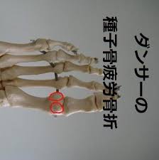 ダンサーの種子骨疲労骨折 ダンサー 筋肉 骨折
