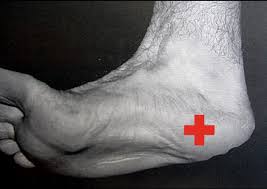 If you have been recently diagnosed with plantar fasciitis, look through the treatment options. Mr Peter Ammon Plantar Fasciitis Murdoch Orthopaedic Clinic