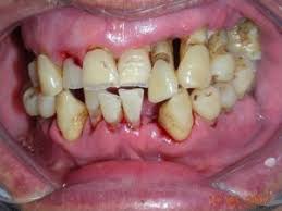 Image result for Periodontitis