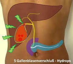 Zu einer anamnese gehört auch eine magenspiegelung, um auszuschließen, dass der magen die ursache ist, sagt berndt birkner vom berufsverband deutscher internisten in wiesbaden.bei folgenden. Gallenblase Op Nurnberg Klinik Hallerwiese De