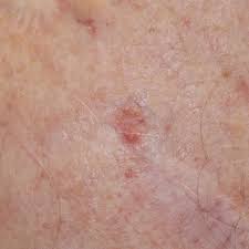 This is one of the most intriguing types of skin cancer growth. Basal Cell Carcinoma Pictures Locations And Symptoms