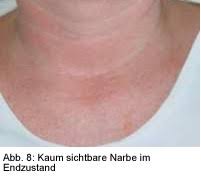 Der faden kann sowohl beim hausarzt als auch in der krankenhausambulanz gezogen werden. Wundheilung Und Narbenbildung St Agatha Krankenhaus