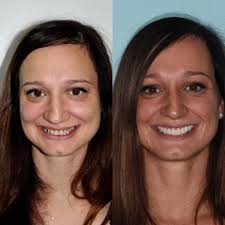 Dental veneers are thin pieces of porcelain that are custom made for each individual patient; Before And After Dental Veneers Weight Loss And Self Care 3 Months Beforeandafter