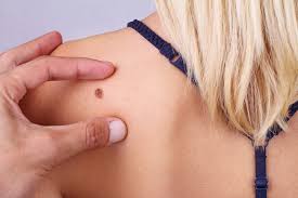 It is also a good idea to talk to your doctor about your level of risk and for advice on early detection. Skin Exam Dermatology Of Virginia