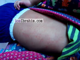 Tidak susah nak hilangkan parut demam campak chicken pox ini. Penyakit Demam Campak Simptom Demam Campak Measles Rubeola Apa Beza Ruam Campak Rubeola Dengan Ruam Roseala Koleksi Resepi Face Mask Kain Cotton Tips Keibubapaan
