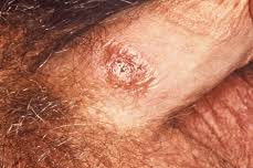Image result for syphilis ulcer