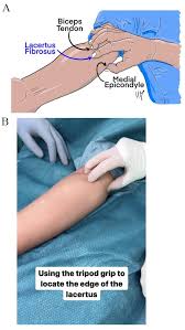 Image result for Carpal Compression Test