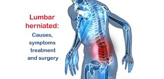 A treatment plan may involve medication, physical therapy, and surgery. How To Help A Slipped Disc In Lower Back