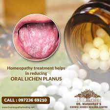 Oral Lichen Planus Is A Cosmic Homeo Healing Centre Facebook