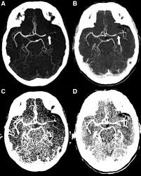 Erleben sie günstige preise und viele kostenlose extras wie proben & zeitschriften. Computed Tomography Angiography In Hyperacute Ischemic Stroke Stroke