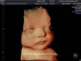 33 Week Baby Girl In Hd Live The 4d Ultrasound Lady Facebook