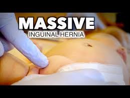 Image result for Inguinal hernia child