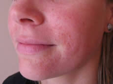 Tinea versicolor kann sich zusammen mit den anderen körperlichen veränderungen entwickeln. Periorale Dermatitis Behandlungen Die Von Den Eisenstadter Hautarzten Dr Rosemarie Moser Und Dr Georg Klein Durchgefuhrt Werden Haut Im Zentrum Eisenstadt