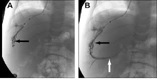 Maybe you would like to learn more about one of these? Biliary Atresia Nine Month Old Male Child Sequential Fluoroscopic Download Scientific Diagram