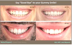Fumiko takatsu august 7 2013 face yoga exercises for the lip area 41 comments. Gummy Smile Plano Tx Lip Injections Frisco Tx