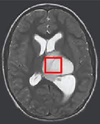 Childhood cancer is cancer in a child. Drugs Against Alpha Ketoglutarate May Combat Deadly Childhood Brain Tumor Eurekalert Science News