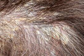 Image result for Seborrheic Dermatitis