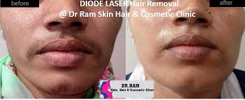 Yag laser systems enable us to safely treat all skin types, while also providing the greatest degree of comfort! Hair Removal Laser Hair Removal Treatment Skin Laser Treatment Mumbai India