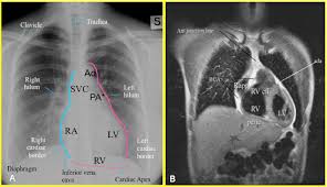 Check spelling or type a new query. Chest X Ray Cardiac Anatomy And Pathology Correlation With Angiocardiography Ct And Mr Imaging Semantic Scholar