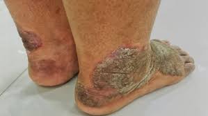 Image result for Lichen Simplex Chronicus