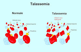 Scopriamo sintomi, diagnosi, cura, trasmissione e alimentazione. Anemia Mediterranea Come Migliorare Con La Dieta Dieta Gruppo Sanguigno