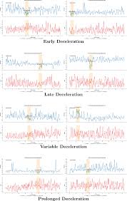 Image result for Early Deceleration
