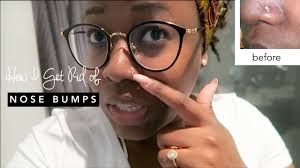 Thanks for watching you guys! How To Get Rid Of A Nose Piercing Bump Keloid Fast Hellotinashe Youtube
