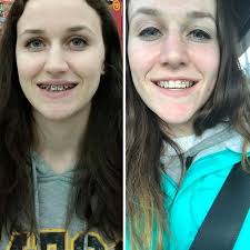 Can an orthodontist refuse to remove braces? Pin On Awesome Stuff