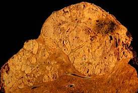 Nora is 2 years old — and she has melanoma. Hepatocellular Carcinoma Wikipedia