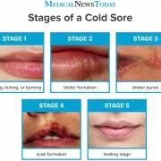 Herpes sores can look a lot like other skin problems, like acne, contact dermatitis, or ingrown hairs. Medical News Today Differentiating Ingrown Hairs And Herpes Central Alabama Wellness
