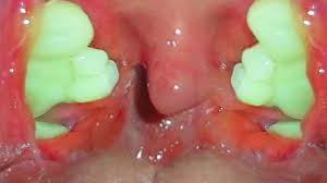 Symptoms may include bad breath. How To Remove Tonsil Stones At Home Medical Videos