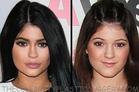 She's the content strategist of. Kylie Jenner Plastic Surgery Before And After Kacie L Flickr
