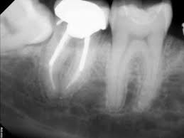 Root canals are one of the most common procedures performed in the dental office. Extraction Of Teeth With Failed Root Canal Treatment Extraction Of Teeth With Failed Root Canal Treatment Kazemi Oral Surgery Facialart Com