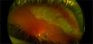 An optomap® retinal exam provides: Commotio Retinae With Vitreous Hemorrhage Sonoran Desert Eye Center