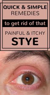 Quick And Simple Remedies To Get Rid Of That Painful And Itchy Stye Beauty Area Skin Tags Home Remedies Skin Care Pimples Skin