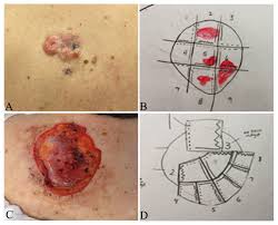 Image result for Dermatofibrosarcoma Protuberans