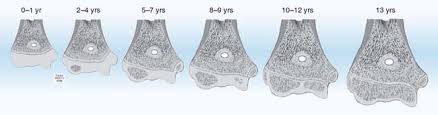 Image result for Humerus Growth Plates