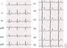Image result for ST Segment