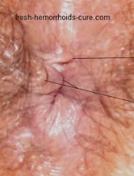 It's not uncommon to always. Hemorrhoid Skin Tag