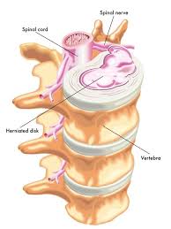 Read about causes, diagnosis, treatment symptoms of a herniated disc in the neck often increase or decrease with neck motion. Herniated Discs And Bulging Discs What S The Difference