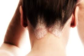 Catrame minerale deriva dalla distillazione a. Dermatite Seborroica Cause Sintomi E Cura