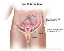 You may receive more than one type of treatment. Cervical Cancer Treatment Pdq Patient Version National Cancer Institute